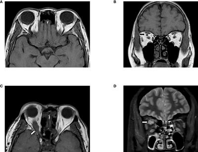 Current insights of applying MRI in Graves’ ophthalmopathy